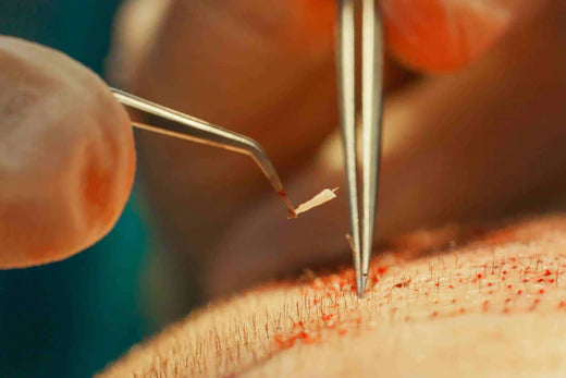 The Risks of Invasive Hair Surgery